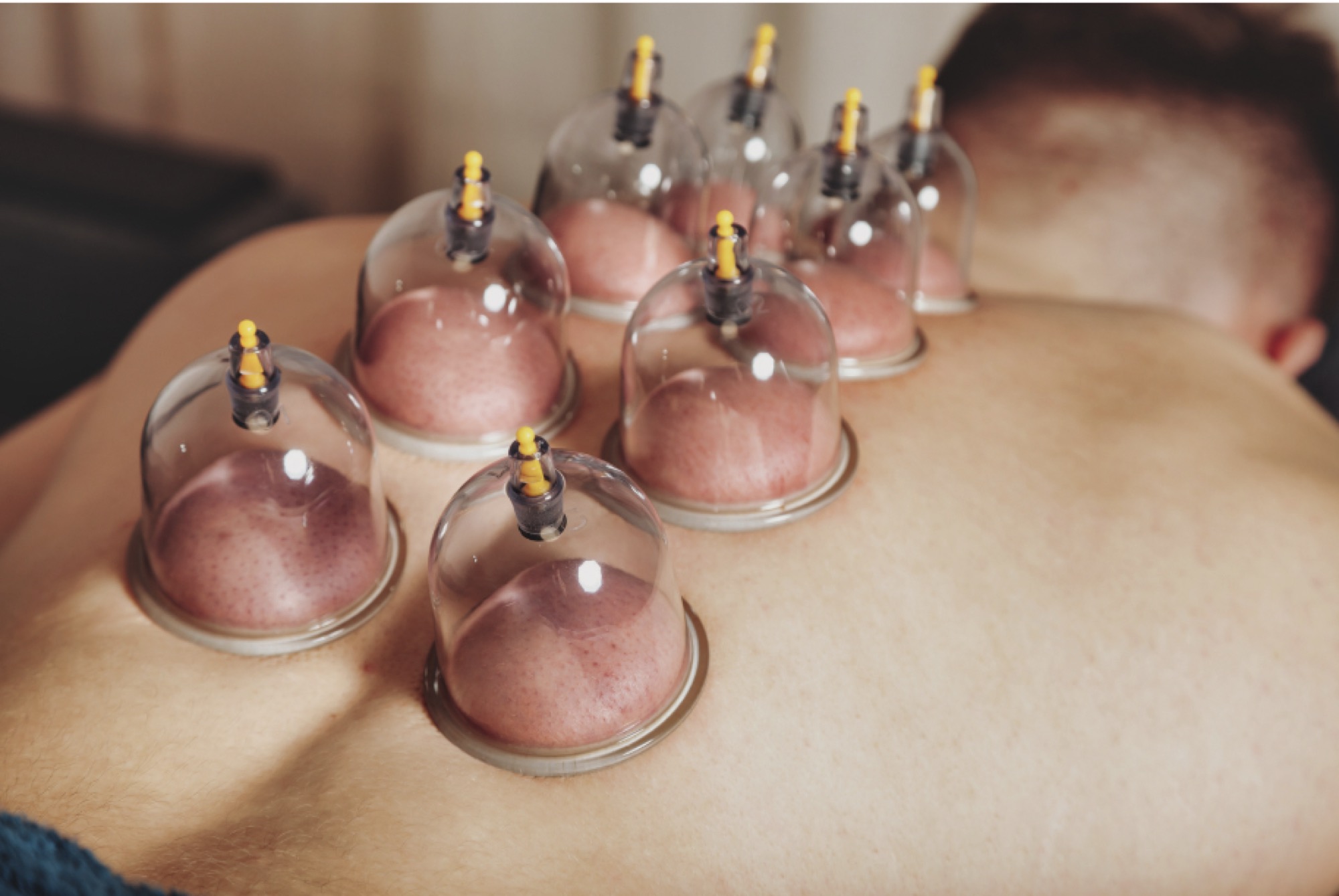 Cupping therapy