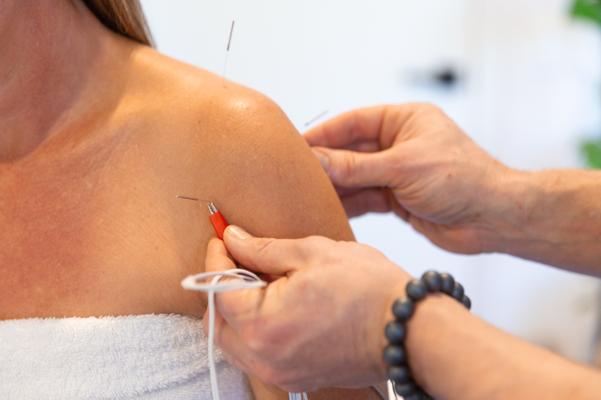 Electro-acupuncture treatment