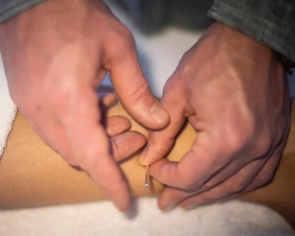 Acupuncture needle insertion